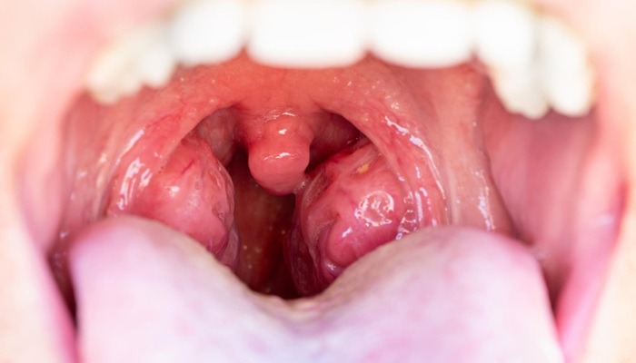 Sourthroat: Guide to Causes, Symptoms, Treatment, and Prevention
